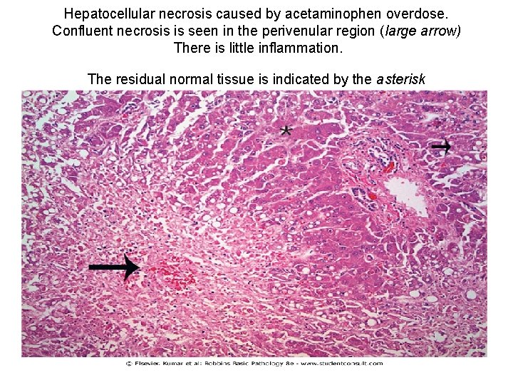 Hepatocellular necrosis caused by acetaminophen overdose. Confluent necrosis is seen in the perivenular region