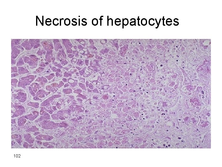 Necrosis of hepatocytes 102 