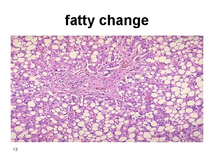 fatty change 13 
