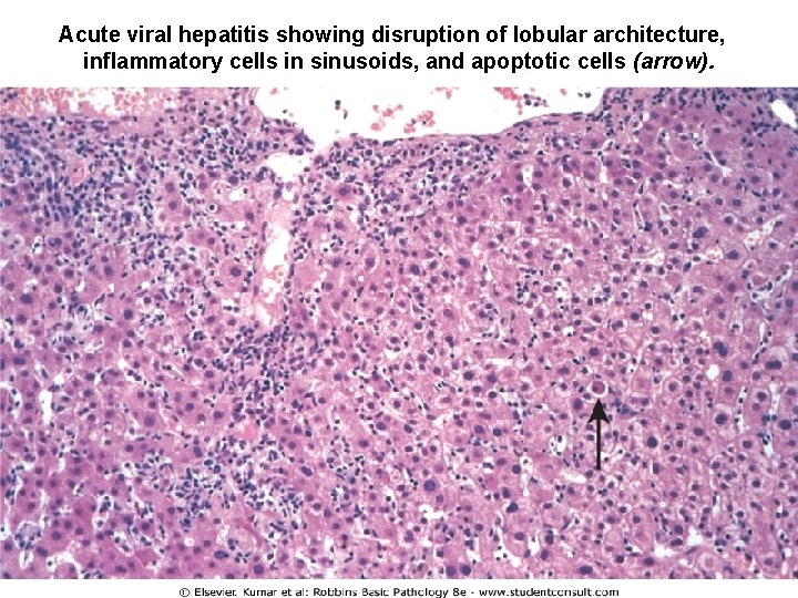 Acute viral hepatitis showing disruption of lobular architecture, inflammatory cells in sinusoids, and apoptotic