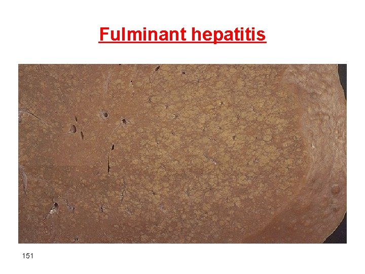 Fulminant hepatitis 151 