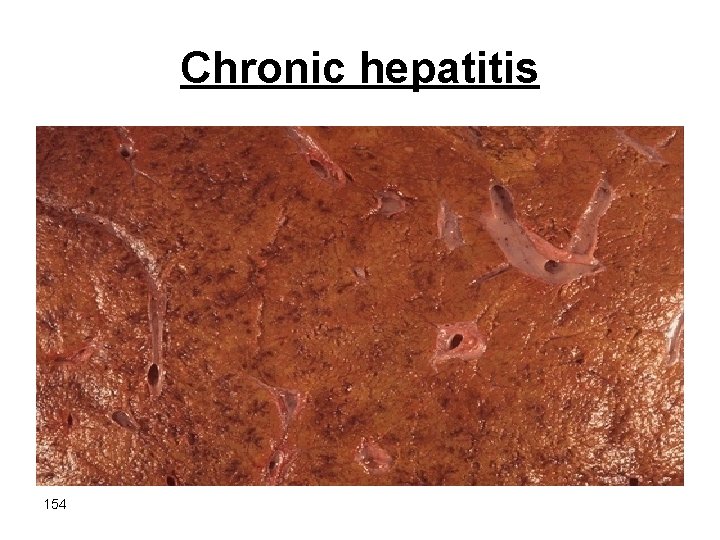 Chronic hepatitis 154 