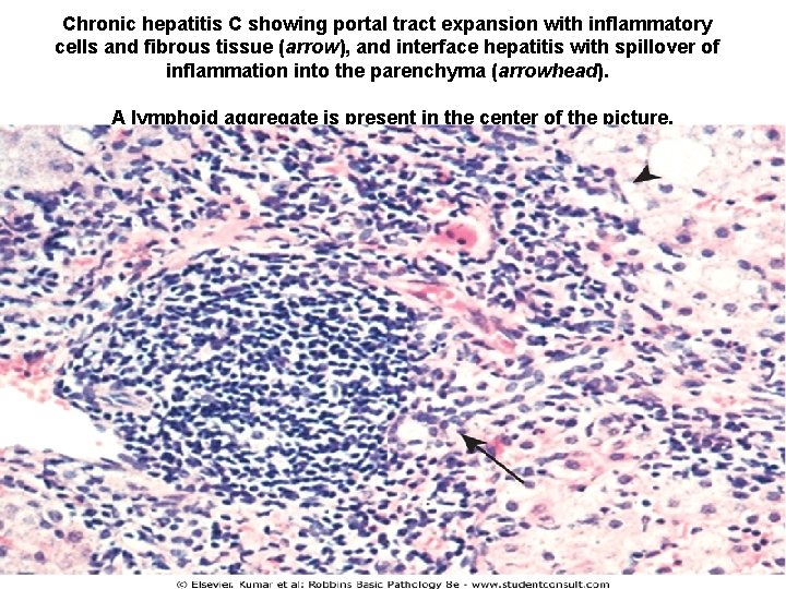 Chronic hepatitis C showing portal tract expansion with inflammatory cells and fibrous tissue (arrow),