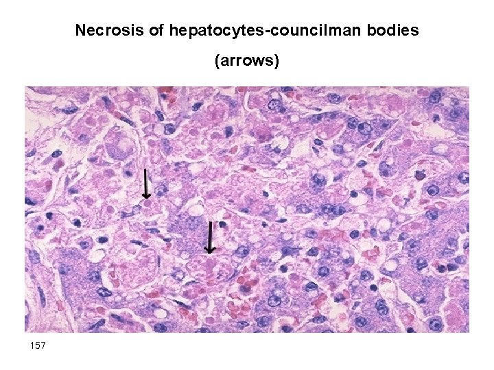 Necrosis of hepatocytes-councilman bodies (arrows) 157 