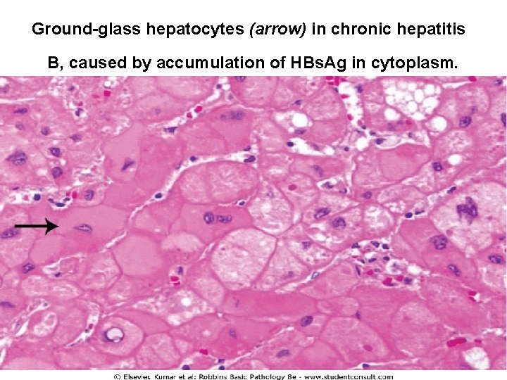 Ground-glass hepatocytes (arrow) in chronic hepatitis B, caused by accumulation of HBs. Ag in