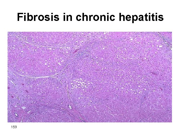 Fibrosis in chronic hepatitis 159 