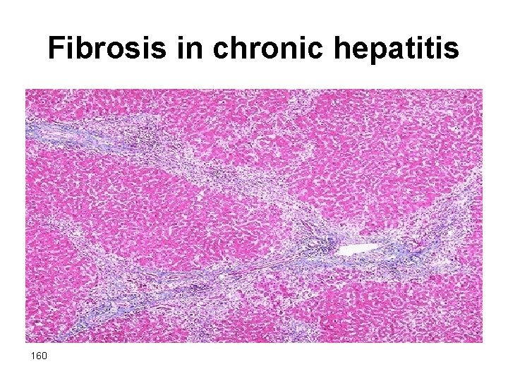 Fibrosis in chronic hepatitis 160 