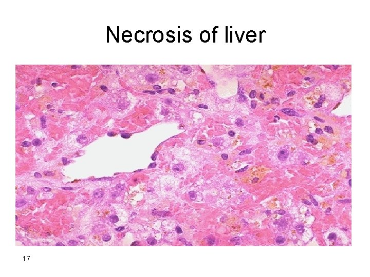 Necrosis of liver 17 