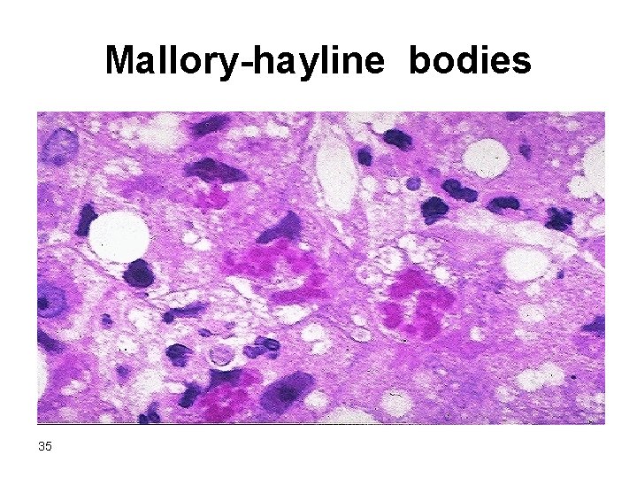 Mallory-hayline bodies 35 