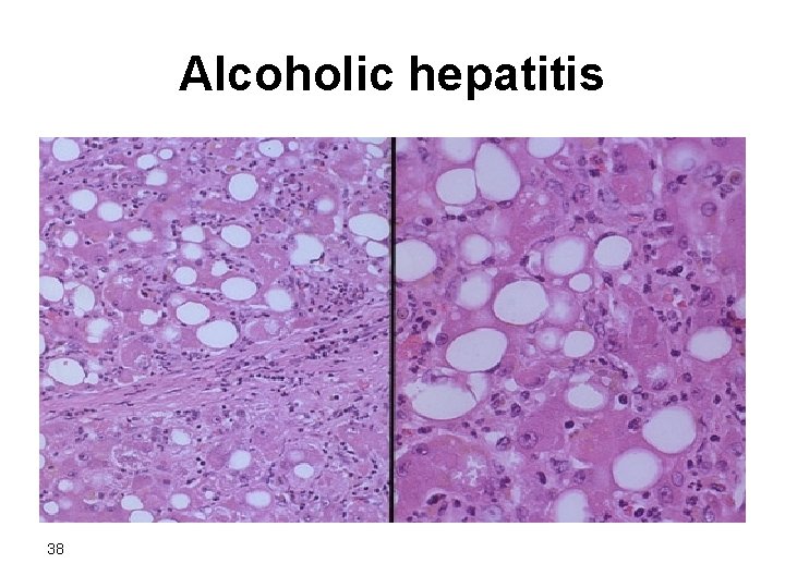 Alcoholic hepatitis 38 