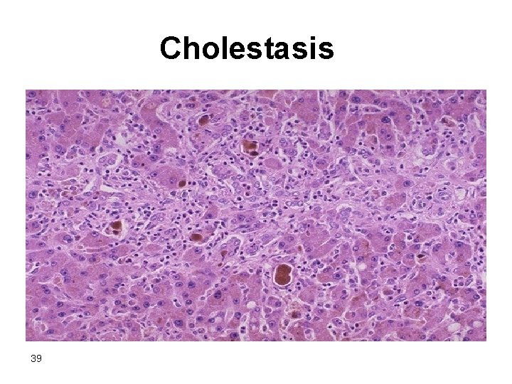 Cholestasis 39 