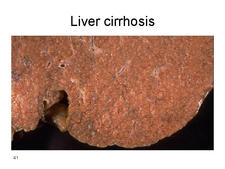 Liver cirrhosis 41 