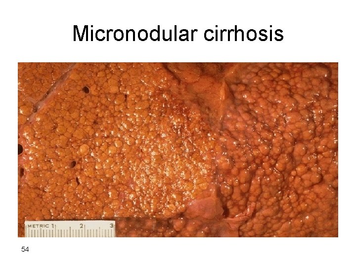 Micronodular cirrhosis 54 