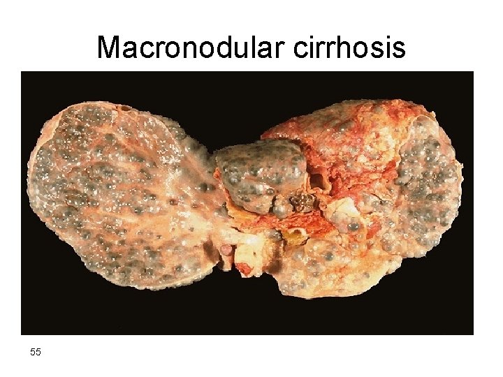 Macronodular cirrhosis 55 