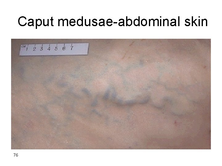 Caput medusae-abdominal skin 76 