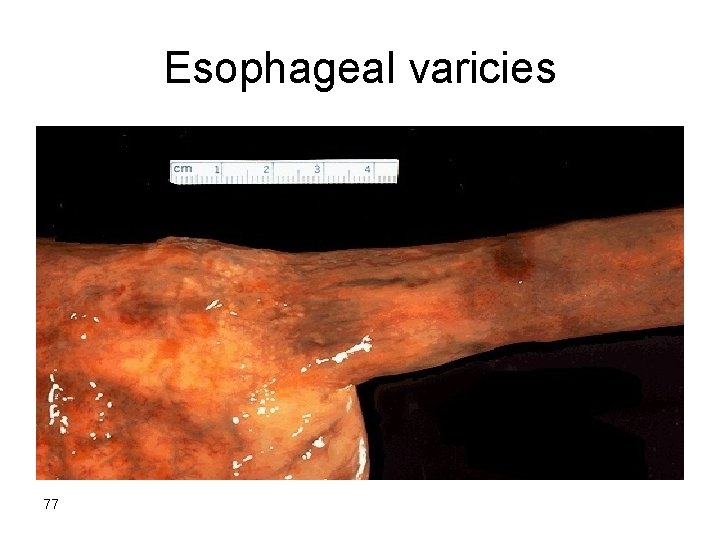 Esophageal varicies 77 