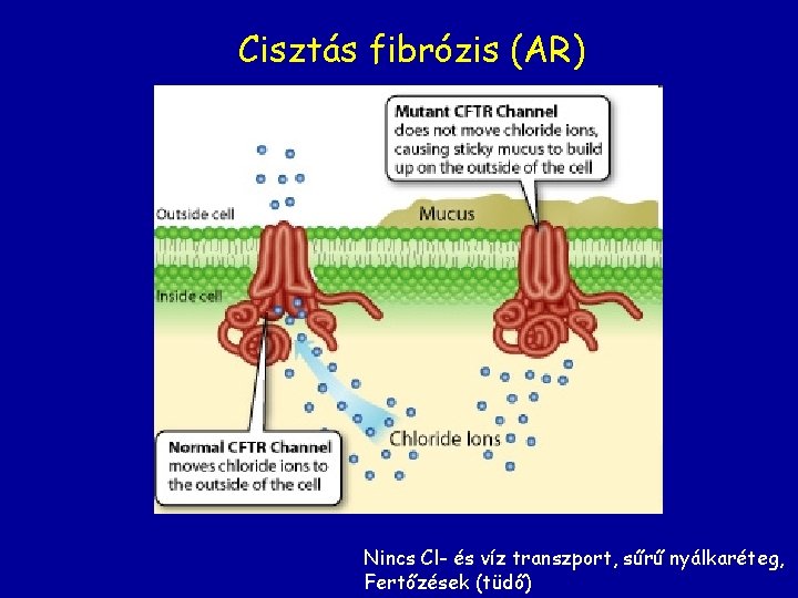 Cisztás fibrózis (AR) Nincs Cl- és víz transzport, sűrű nyálkaréteg, Fertőzések (tüdő) 