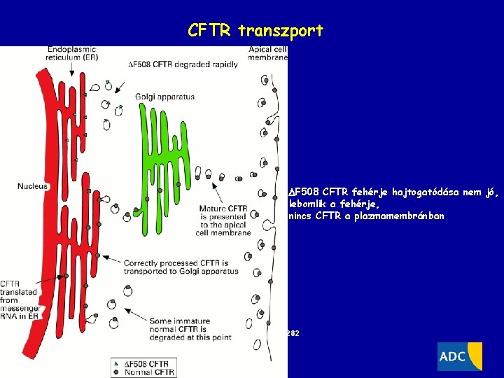 CFTR transzport F 508 CFTR fehérje hajtogatódása nem jó, lebomlik a fehérje, nincs CFTR