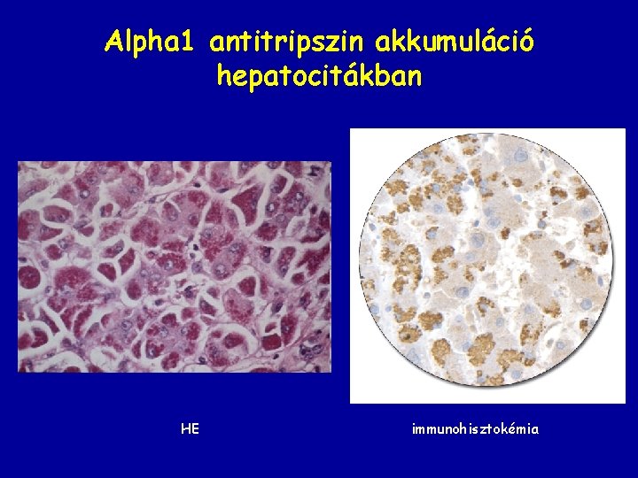 Alpha 1 antitripszin akkumuláció hepatocitákban HE immunohisztokémia 