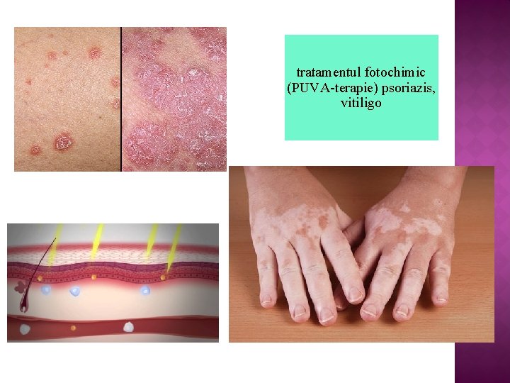 tratamentul fotochimic (PUVA-terapie) psoriazis, vitiligo 
