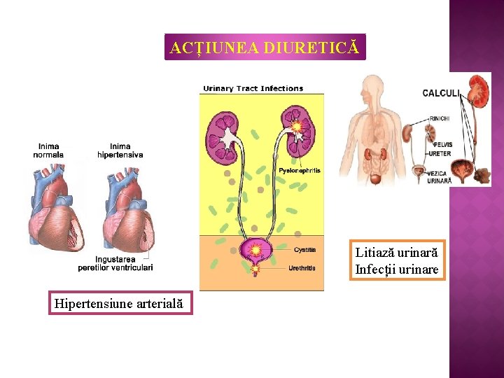 ACȚIUNEA DIURETICĂ Litiază urinară Infecții urinare Hipertensiune arterială 