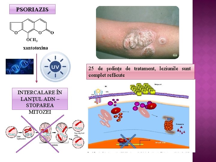 PSORIAZIS 25 de şedinţe de tratament, leziunile sunt complet refăcute INTERCALARE ÎN LANŢUL ADN