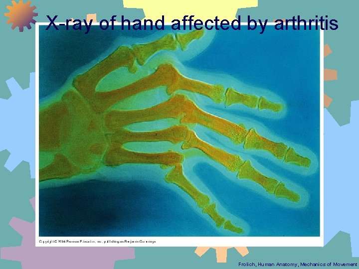 X-ray of hand affected by arthritis Frolich, Human Anatomy, Mechanics of Movement 