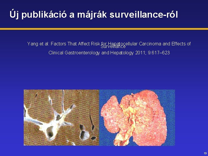 Új publikáció a májrák surveillance-ról Yang et al: Factors That Affect Risk for Hepatocellular