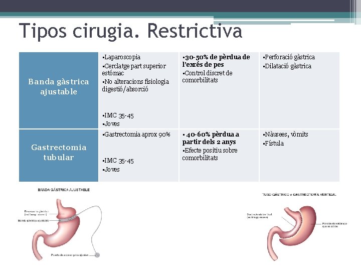 Tipos cirugia. Restrictiva Banda gàstrica ajustable • Laparoscopia • Cerclatge part superior estómac •