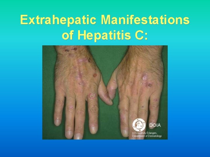 Extrahepatic Manifestations of Hepatitis C: 