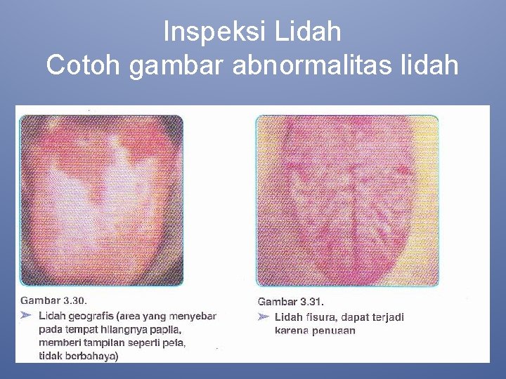 Inspeksi Lidah Cotoh gambar abnormalitas lidah 