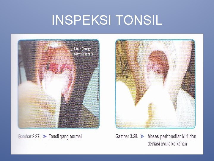 INSPEKSI TONSIL 