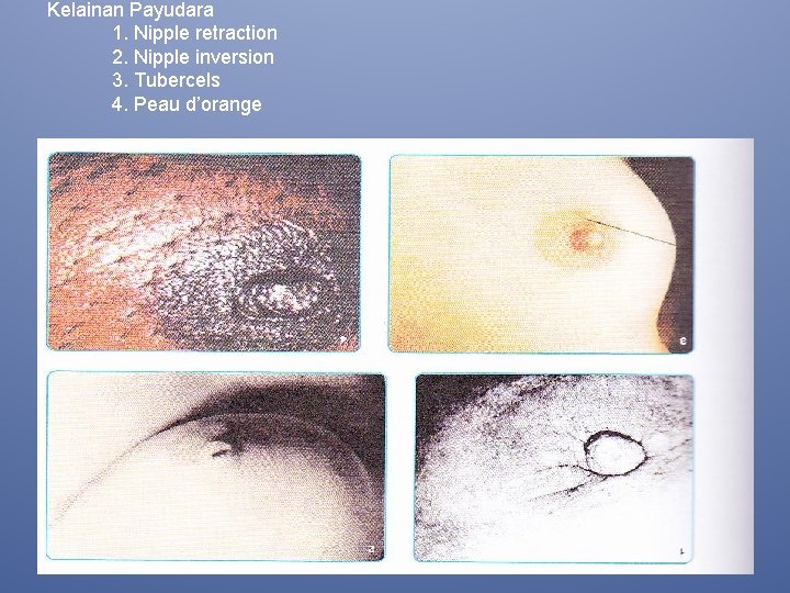 Kelainan Payudara 1. Nipple retraction 2. Nipple inversion 3. Tubercels 4. Peau d’orange 