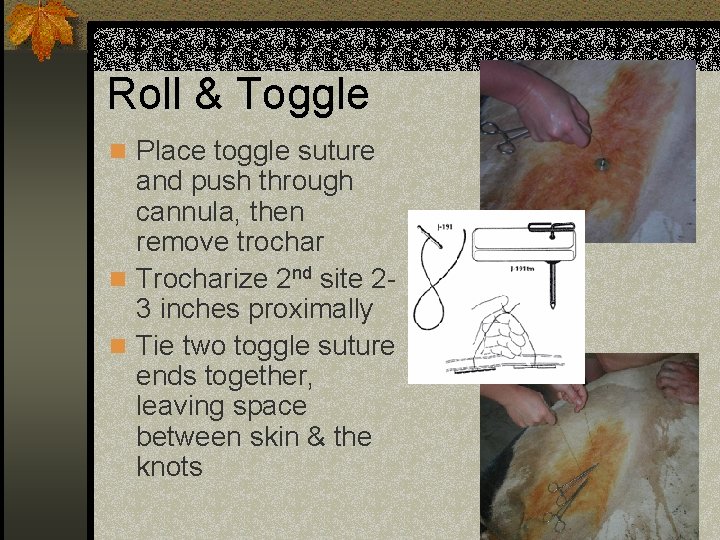 Roll & Toggle n Place toggle suture and push through cannula, then remove trochar