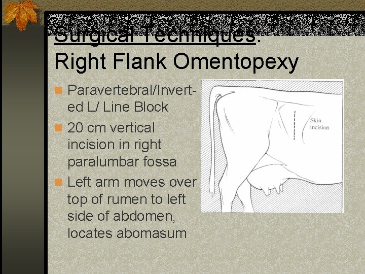 Surgical Techniques: Right Flank Omentopexy n Paravertebral/Invert- ed L/ Line Block n 20 cm