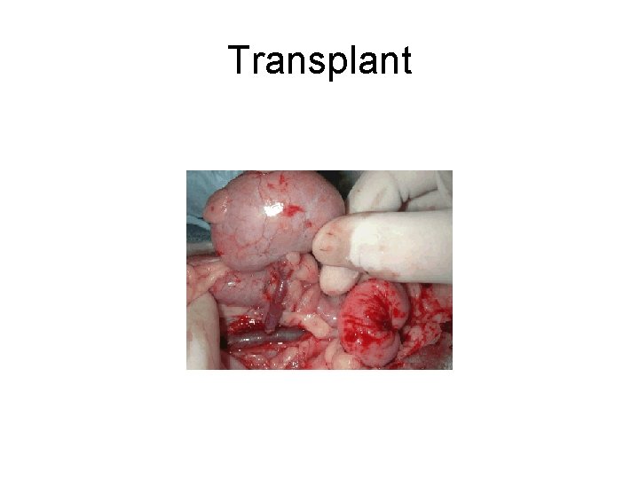 Transplant 
