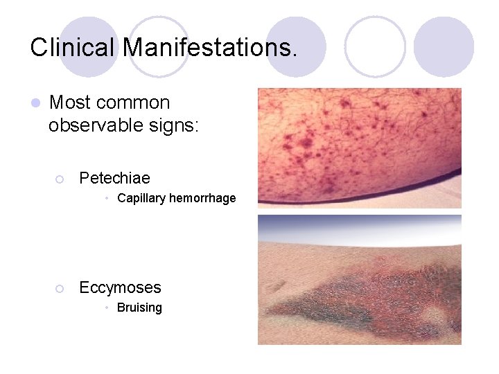 Clinical Manifestations. l Most common observable signs: ¡ Petechiae • Capillary hemorrhage ¡ Eccymoses