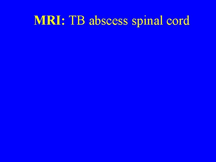 MRI: TB abscess spinal cord 