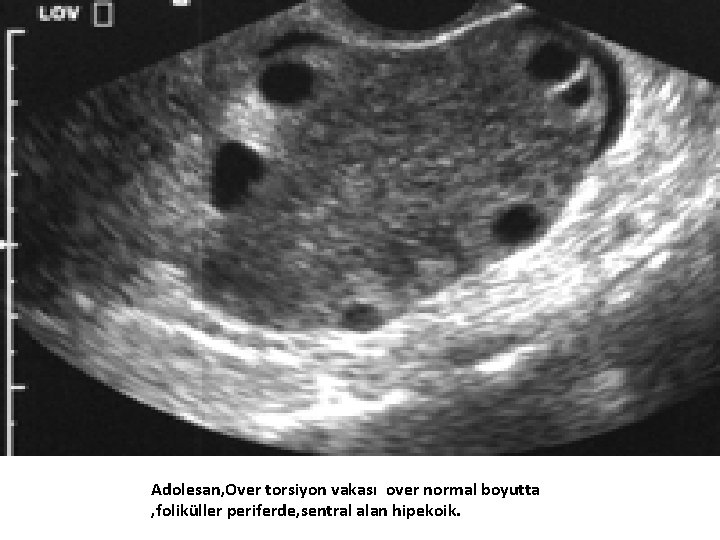 Adolesan, Over torsiyon vakası over normal boyutta , foliküller periferde, sentral alan hipekoik. 