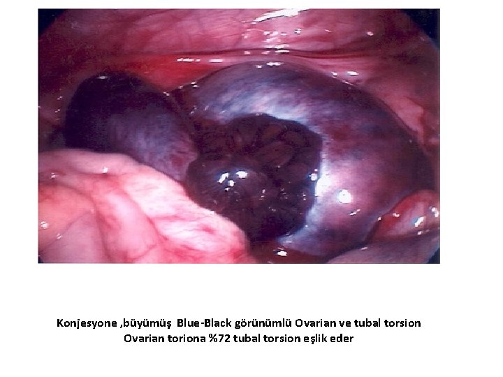 Konjesyone , büyümüş Blue-Black görünümlü Ovarian ve tubal torsion Ovarian toriona %72 tubal torsion