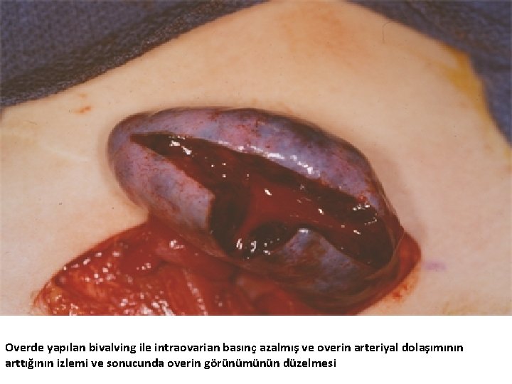 Overde yapılan bivalving ile intraovarian basınç azalmış ve overin arteriyal dolaşımının arttığının izlemi ve