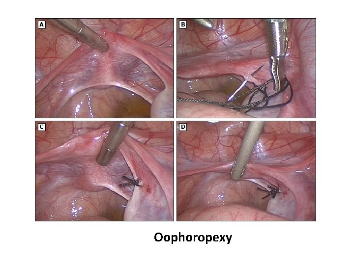  Oophoropexy 