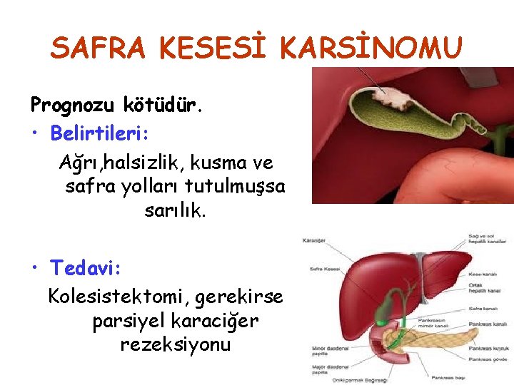 SAFRA KESESİ KARSİNOMU Prognozu kötüdür. • Belirtileri: Ağrı, halsizlik, kusma ve safra yolları tutulmuşsa