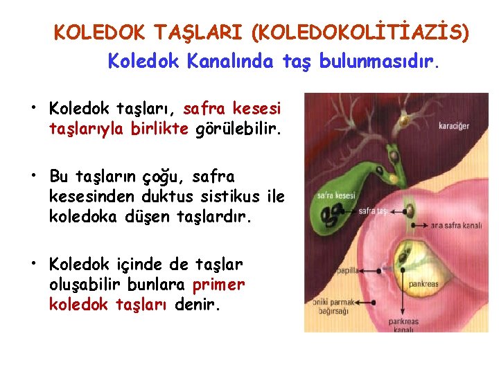 KOLEDOK TAŞLARI (KOLEDOKOLİTİAZİS) Koledok Kanalında taş bulunmasıdır. • Koledok taşları, safra kesesi taşlarıyla birlikte