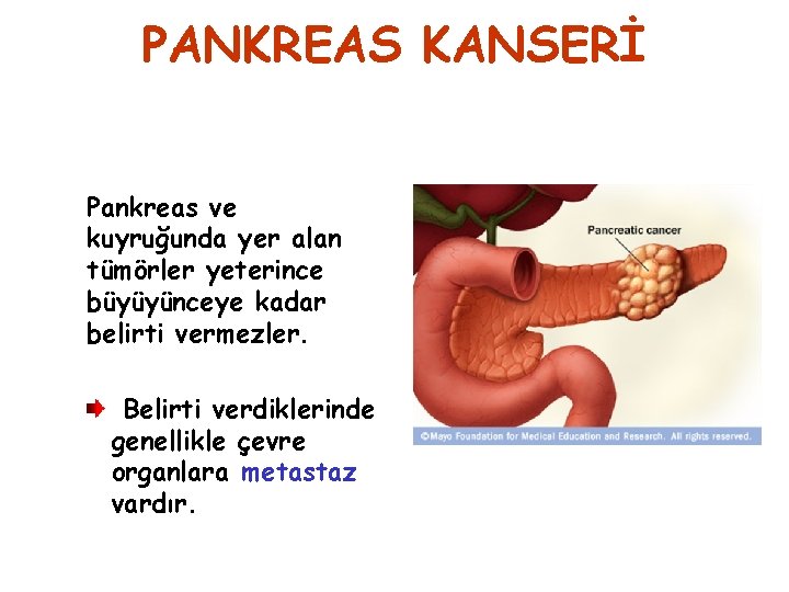 PANKREAS KANSERİ Pankreas ve kuyruğunda yer alan tümörler yeterince büyüyünceye kadar belirti vermezler. Belirti