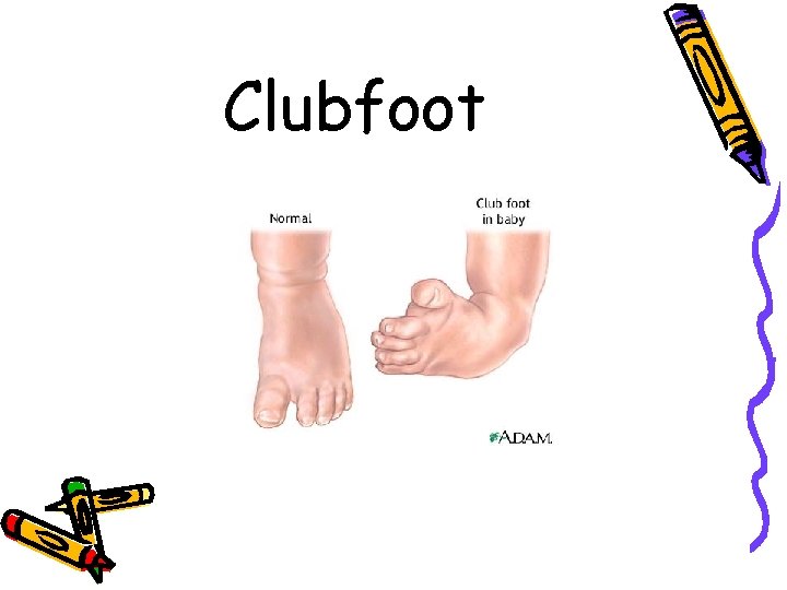 Clubfoot 