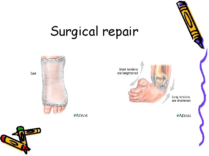 Surgical repair Surgical repair
