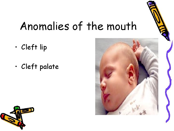 Anomalies of the mouth • Cleft lip • Cleft palate Anomalies of the mouth • Cleft lip • Cleft palate