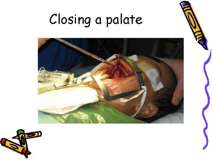 Closing a palate Closing a palate