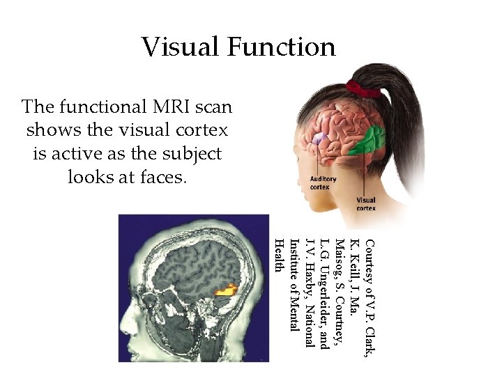 Visual Function The functional MRI scan shows the visual cortex is active as the